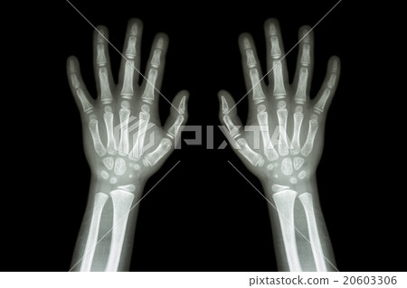 Film X-ray normal both hands of child 20603306