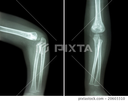 Film x-ray of child 's elbow  20603310
