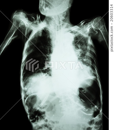 Pulmonary Tuberculosis  20603314