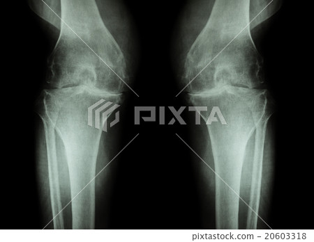Osteoarthritis Knee ( OA Knee ) Osteoarthritis Knee ( OA Knee ) 20603318