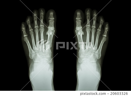 Film x-ray both foot ( front view ) 20603326