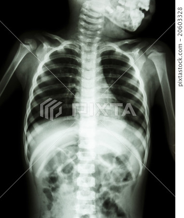 Chest X-ray of child 20603328