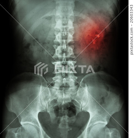 Kidney stone ( renal stone , renal calculi ) Kidney stone ( renal stone , renal calculi ) 20603343