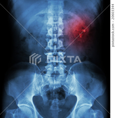 Kidney stone ( renal stone , renal calculi ) Kidney stone ( renal stone , renal calculi ) 20603344
