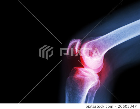 Film x-ray knee joint with arthritis Film x-ray knee joint with arthritis 20603347
