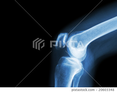 Film x-ray knee joint with arthritis Film x-ray knee joint with arthritis 20603348