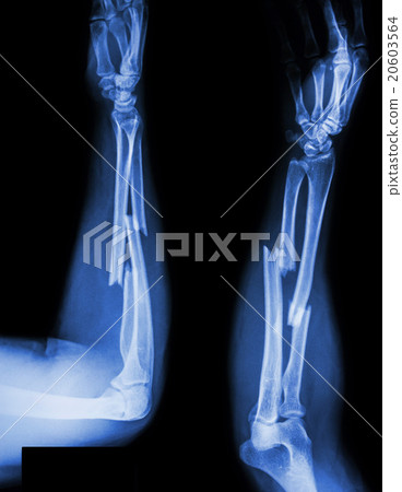 fracture shaft of radius & ulnar bone 20603564