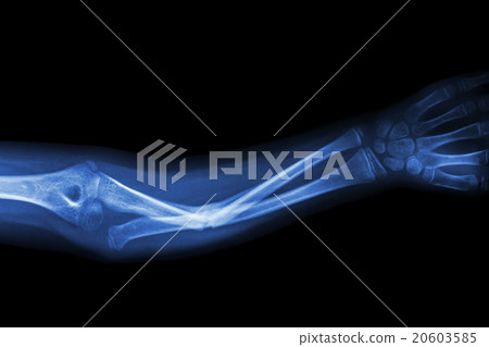 Fracture ulnar bone (forearm bone) Fracture ulnar bone (forearm bone) 20603585