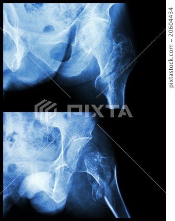 Fracture head of femur(Thigh bone) Fracture head of femur(Thigh bone) 20604434