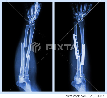 Fracture both bone of forearm Fracture both bone of forearm 20604444