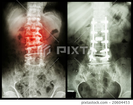 "Spondylosis" "Spondylosis" 20604453