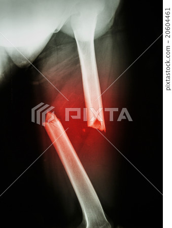 fracture femur 20604461