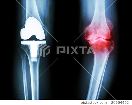film x-ray knee of osteoarthritis knee  20604462
