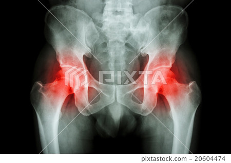 Film x-ray pelvis and arthritis both hip Film x-ray pelvis and arthritis both hip 20604474