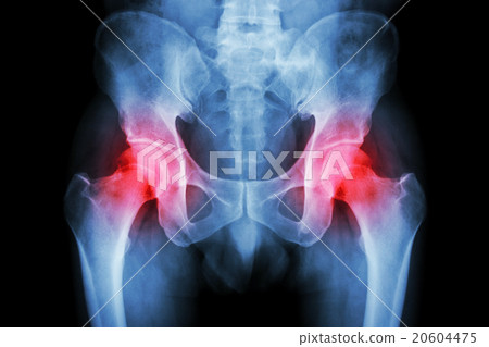 Film x-ray pelvis and arthritis both hip Film x-ray pelvis and arthritis both hip 20604475