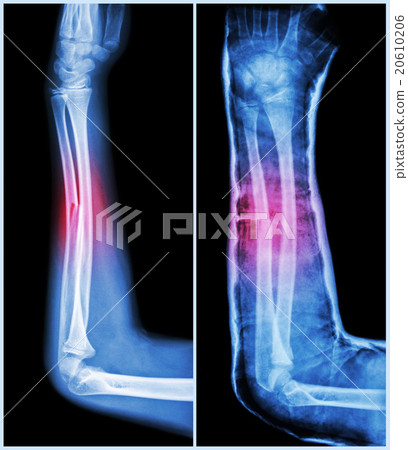 Fracture shaft of ulnar bone ( forearm bone ) 20610206