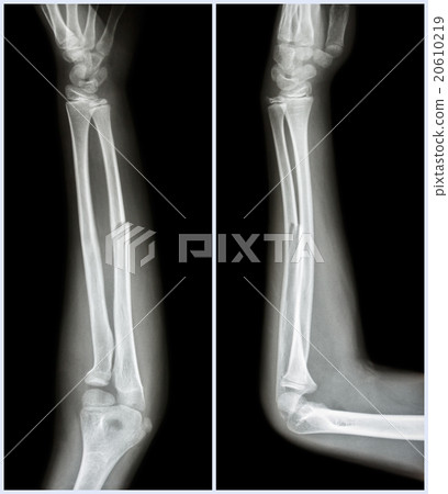 Fracture shaft of ulnar bone ( forearm bone ) 20610219