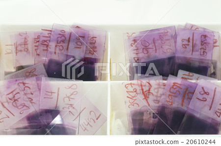 Peripheral Blood Smear (PBS) Peripheral Blood Smear (PBS) 20610244