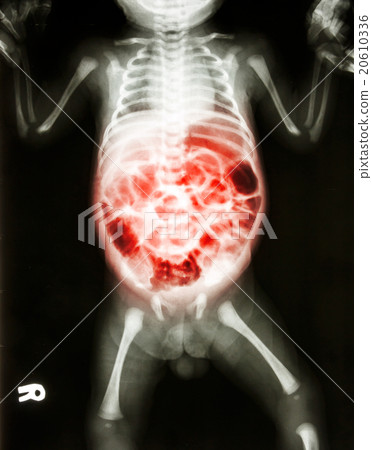 Enteritis Enteritis 20610336