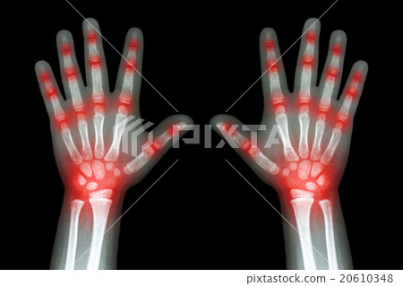 Rheumatoid arthritis  20610348