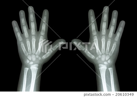 X-ray both child hands on black background X-ray both child hands on black background 20610349