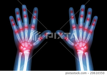 Rheumatoid arthritis Rheumatoid arthritis 20610350
