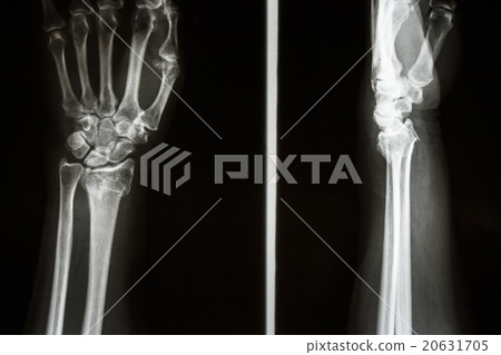 Colles' fracture 20631705