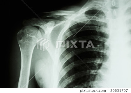 fracture middle right clavicle 20631707