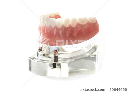 超過假牙 超過假牙 20644666
