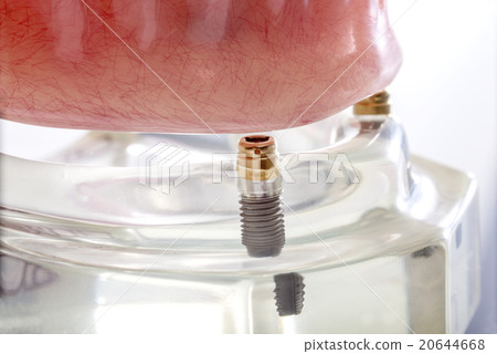 Over Denture 20644668