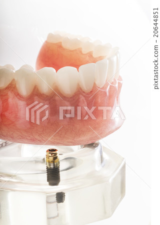 超過假牙 20644851