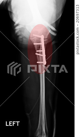 Fracture Elbow, forearm x-rays image 20697313