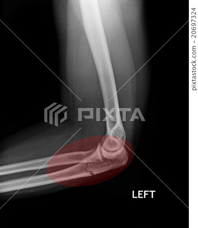 Fracture Elbow, forearm x-rays image 20697324