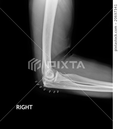 Fracture Elbow, forearm x-rays image 20697341