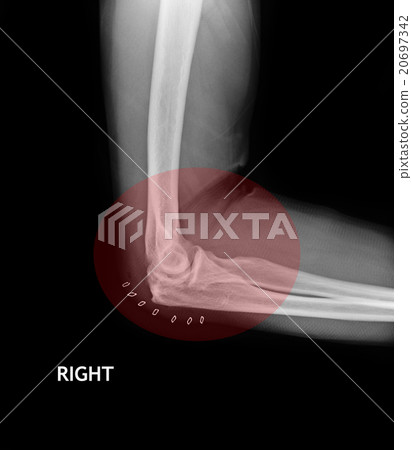 Fracture Elbow, forearm x-rays image 20697342