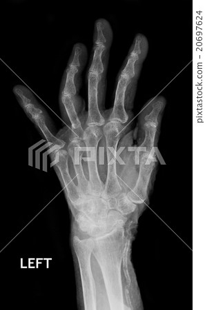 X-Ray Hand. 20697624