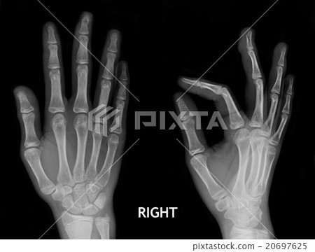 X-Ray Hand. 20697625