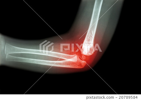 Rheumatoid arthritis , Gouty arthritis  20789584