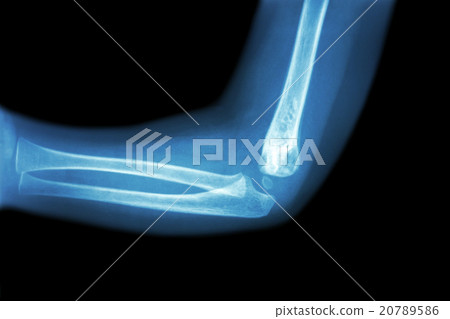 Film x-ray of child 's elbow 20789586