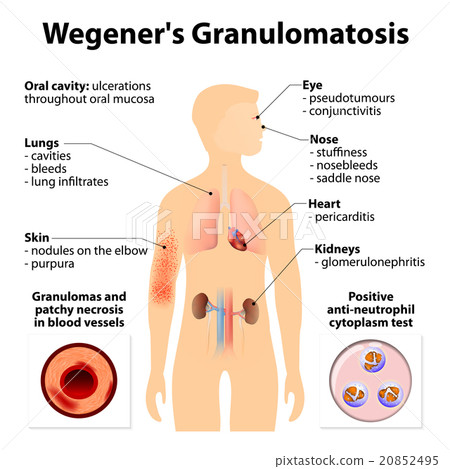 Granulomatosis 20852495