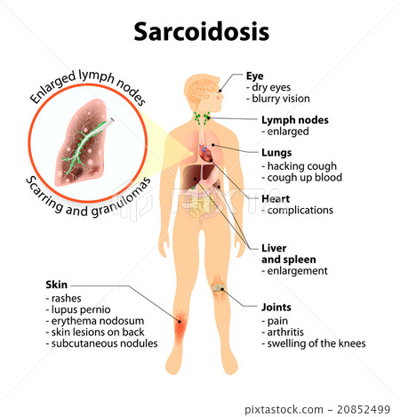 Sarcoidosis signs and symptoms 20852499