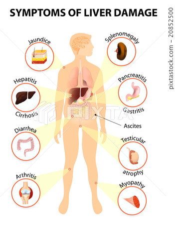 Symptoms Of Liver Disease 20852500