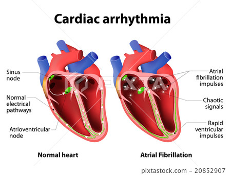 Cardiac arrhythmia 20852907
