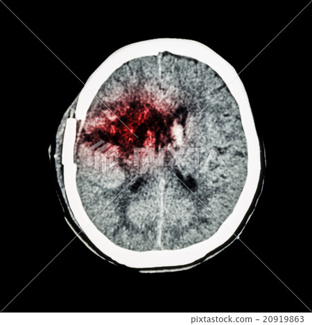 right basal ganglia hemorrhage with brain edema right basal ganglia hemorrhage with brain edema 20919863