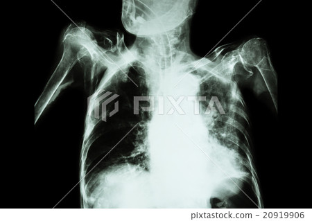 Pulmonary Tuberculosis Pulmonary Tuberculosis 20919906