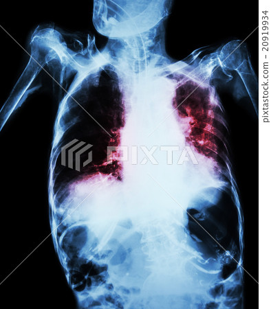 Pulmonary Tuberculosis 20919934