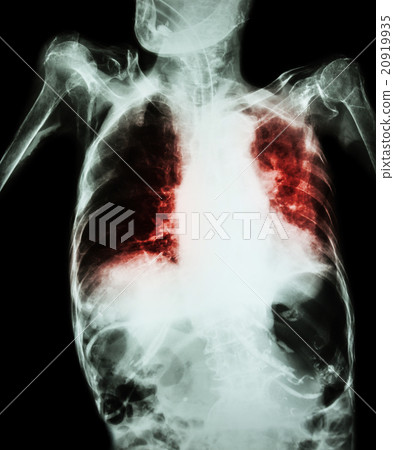 Pulmonary Tuberculosis Pulmonary Tuberculosis 20919935