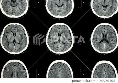 CT scan of brain show normal brain CT scan of brain show normal brain 20920108