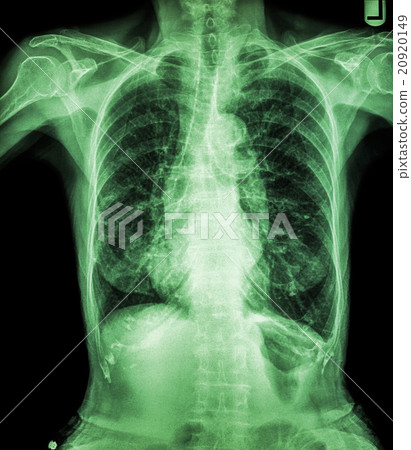 Chest X-ray of old patient Chest X-ray of old patient 20920149