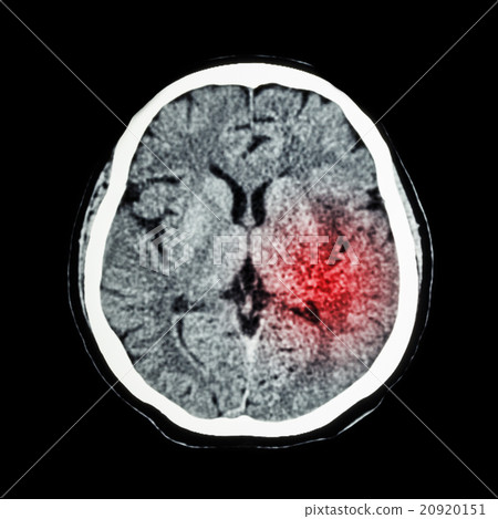 Ischemic Stroke or Hemorrhagic Stroke Ischemic Stroke or Hemorrhagic Stroke 20920151